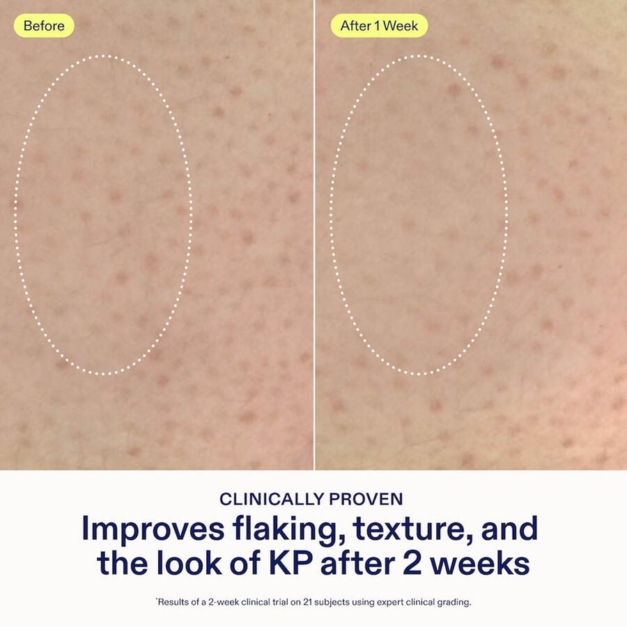 Skinfix KP PsO Smoothing Body Treatment, 5.07 fl. oz., , large image number 3