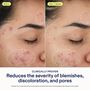 SkinFix 2% BHA Cleanser, 5 fl. oz., , large image number 3